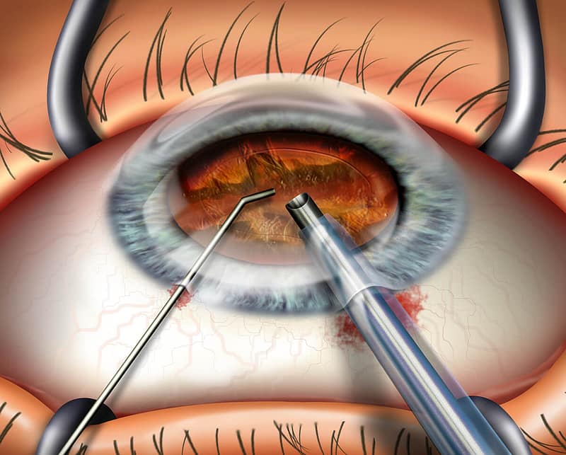 Cataract illustration